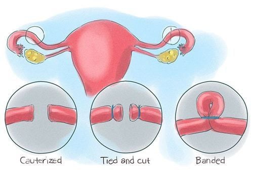 Does Tubal Ligation Affect Menstrual Cycles?