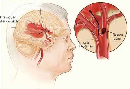 Cerebral hemorrhage is highly dangerous, with severe complications and high mortality rates.