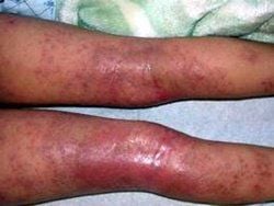 Muscle abscess due to infection: Don't underestimate it