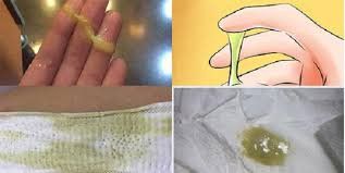 Yellow or Green Clumpy Vaginal Discharge: What Does It Indicate?