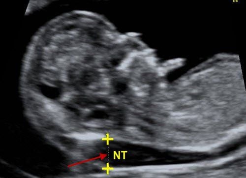 Is a nuchal translucency measurement of 1.2mm after 12 weeks of pregnancy a concern?