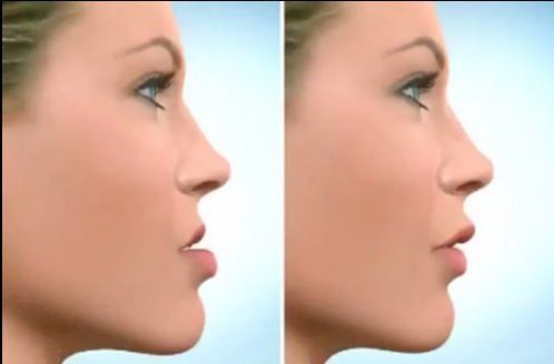 Facial changes before and after orthodontics