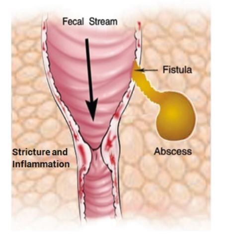 Narrowing of the digestive tract causing intestinal obstruction, with constipation being one of the complications of Crohn's disease