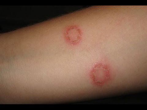 Is tinea corporis dangerous?