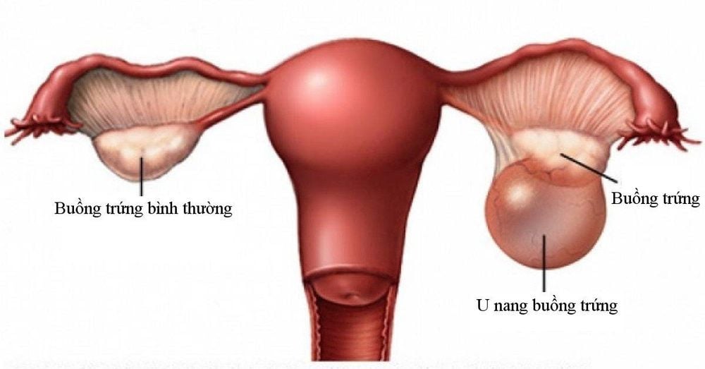 Ovarian cysts may not disappear on their own and need to be surgically removed. 