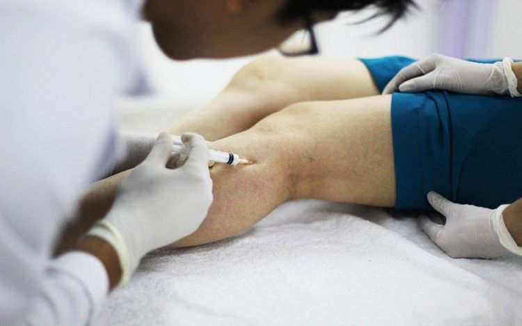 Sclerotherapy for Varicose Veins