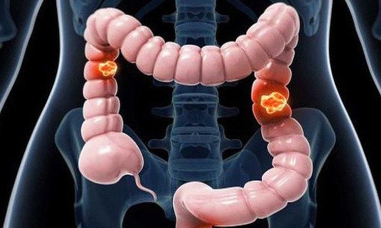 Colon polyps can develop into cancer if left for too long
