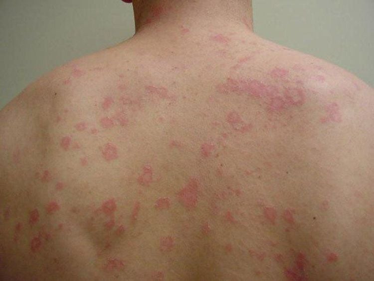 Gibert’s pityriasis rosea is a contagious disease that can transmit from one person to another.