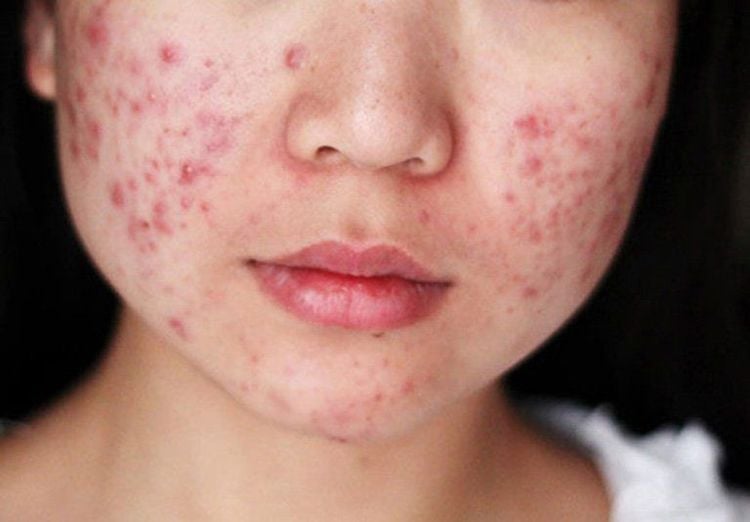 The cause of melasma and freckles in puberty is also due to post-inflammatory skin recovery, acne,...
