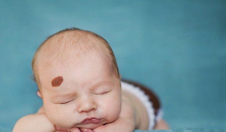 Hemangiomas and lumps on the back of the head are related

