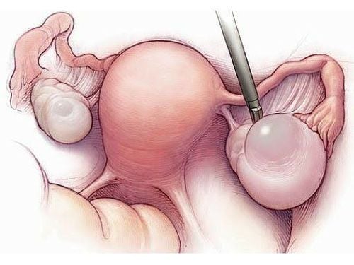 At what size should an ovarian cyst be operated depends on many different factors 