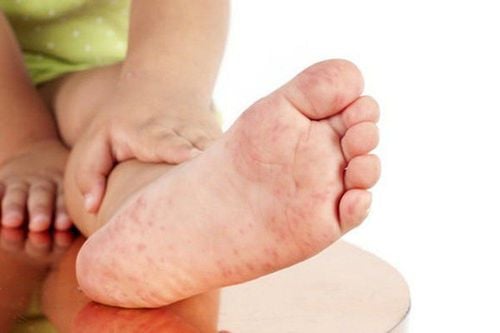 Hand, foot, and mouth disease: Warning signs indicating the risk of complications