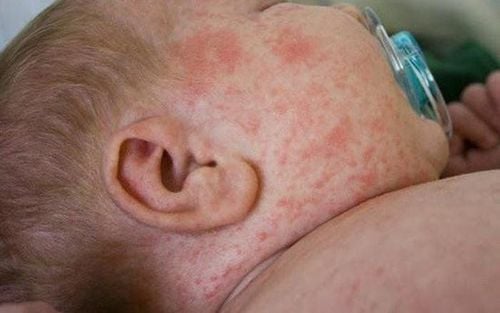 Recognizing Dengue fever in infants under 1 year old