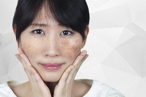 Distinguishing hormonal melasma from common melasma