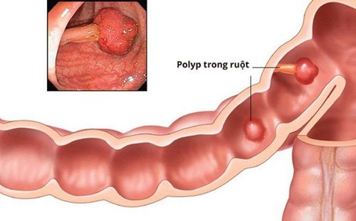 Some common types of colon polyps in children.
