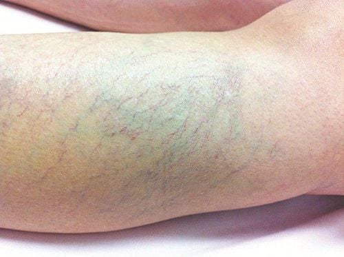Images of varicose veins in the legs.