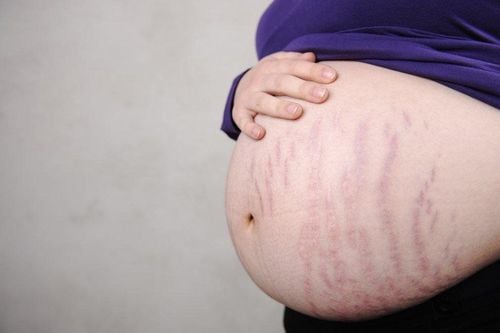 Stretch Marks During Pregnancy: Why Some Get Them and Some Don't
