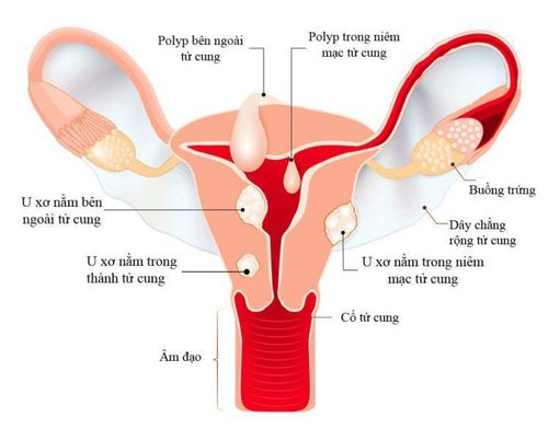 The appropriate treatment method is cervical fibroid resection.
