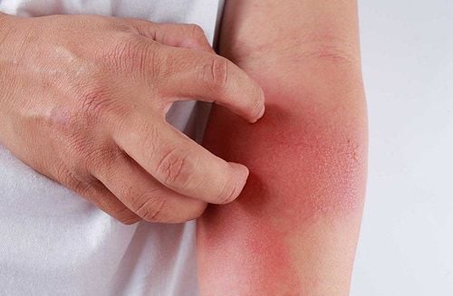 What to do when experiencing an allergic reaction to mosquito repellent spray?