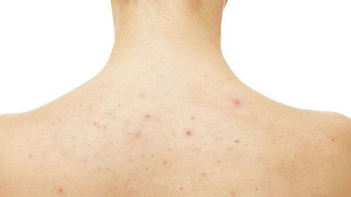 Folliculitis recurrence, what to do?