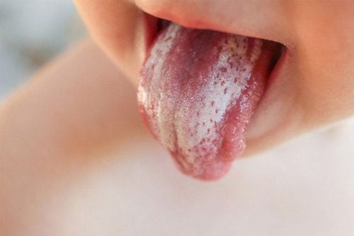 White patches in a child’s mouth: What could it be?