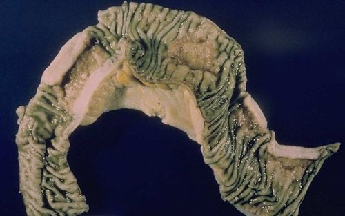 Is Intestinal Tuberculosis Dangerous and Contagious?