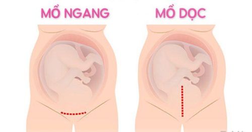 Should the cesarean section be performed with a horizontal or vertical incision?