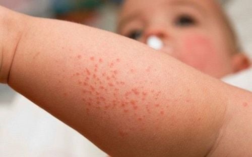 Children may experience pruritus due to various causes, not solely related to hepatic issues.
