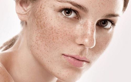 How to eliminate freckles? 