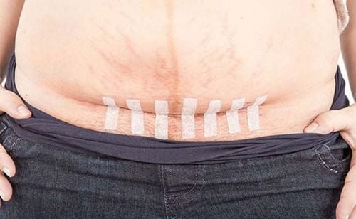 After a cesarean, you should only shower when necessary and try to keep the incision dry.
