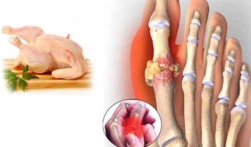 Can people with gout eat chicken?