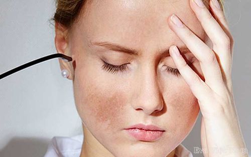 Melasma makes women lose their confidence.