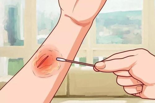 Should 70% Alcohol Be Used to Clean Wounds?