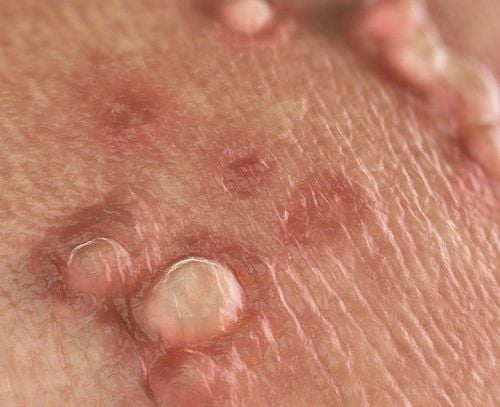 Understanding Types of Genital Pimples in Men and Women