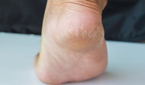 What nutrient deficiencies cause cracked heels?