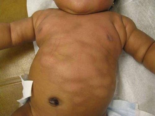 Actual images of tinea versicolor in children