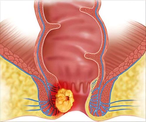 Hard Lump in the Anal Area: Is It Anal Cancer?