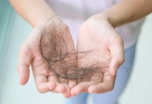 Hair Loss After Dengue Fever