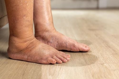 Gout can cause foot dorsal foot edema.