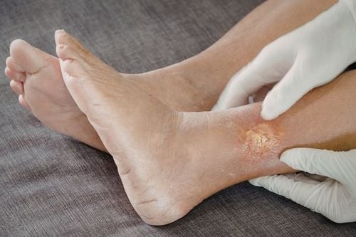 Proper care is essential for those experiencing dorsal foot edema.