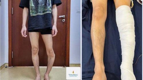 Before and after images of the patient's lower leg correction surger