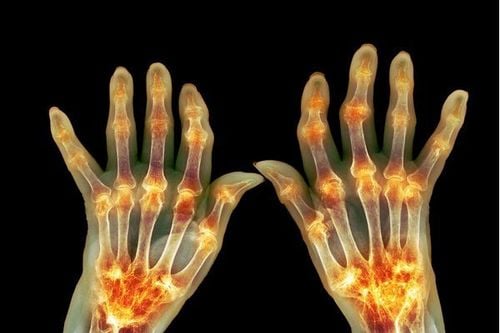 Rheumatoid Arthritis: Causes, Symptoms, Diagnosis, and Treatment