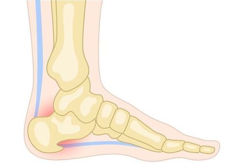 Treatment Protocol for Heel Spurs