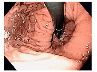 Figure 5: A case of a patient with reflux esophagitis who did not respond to acid secretion inhibitors, with a Hill grade 4 gastroesophageal junction valve.
