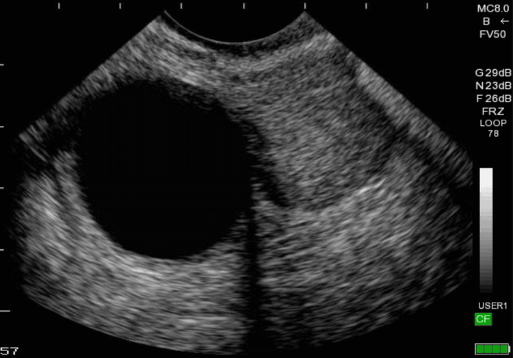 Ultrasound image of an ovarian cyst


