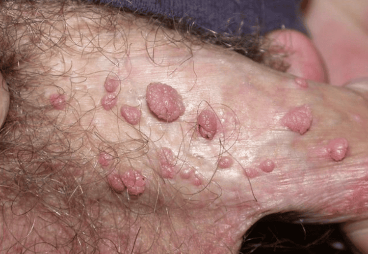 Images of genital warts in men.