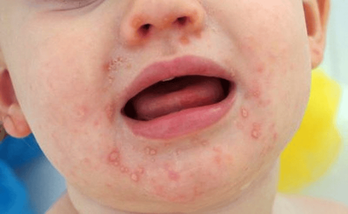 Reasons why hand-foot-mouth disease (HFMD) can recur many times