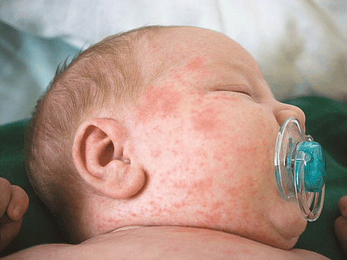 Home Nutritional Care Guide for Children with Measles