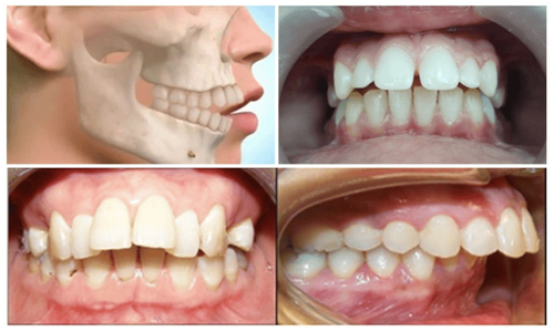 Upper jaw misalignment often leads to a horizontal overbite.