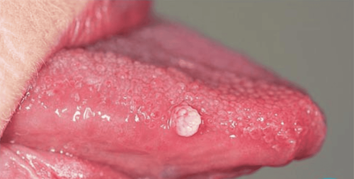 Genital Warts in the Oral Cavity: How to Treat Lesions Under the Tongue